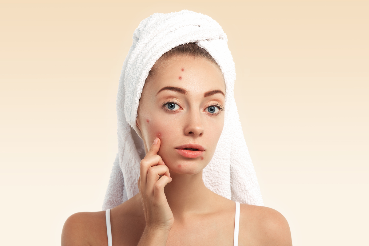  Acne Routine
